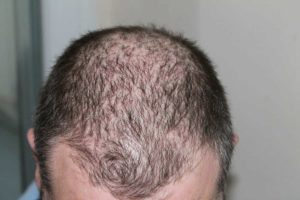 Facts About Hair Loss You Should Know About Now
