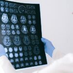 Long-Term Effects Of Traumatic Brain Injury
